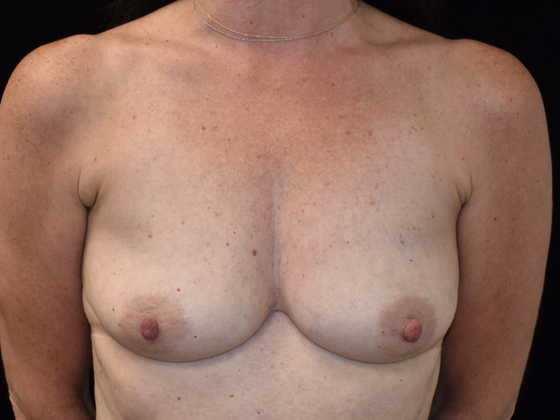 Mastopexy with Augmentation: Case 2 - Before