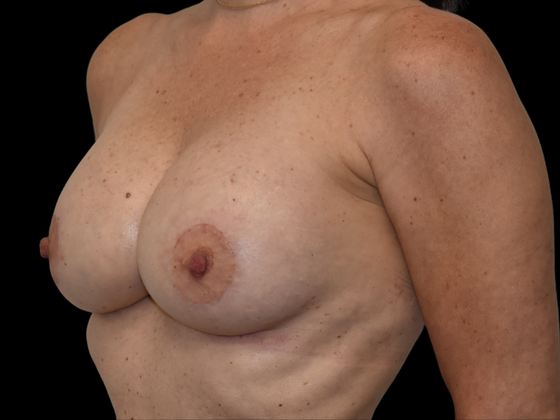 Mastopexy with Augmentation: Case 2 - After