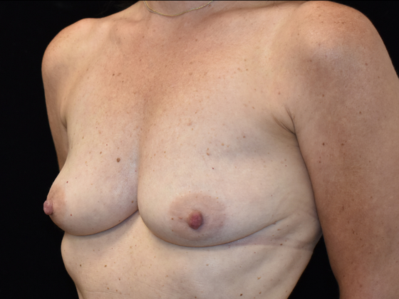 Mastopexy with Augmentation: Case 2 - Before