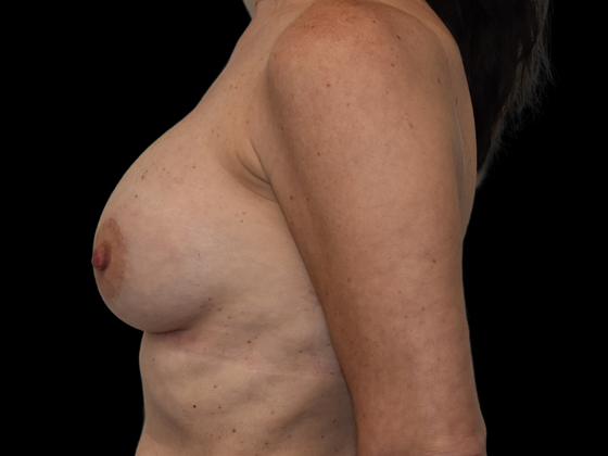 Mastopexy with Augmentation: Case 2 - After