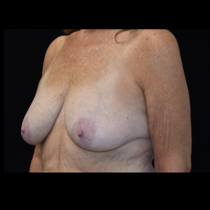 Mastopexy with Augmentation: Case 3 - Before