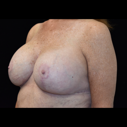 Mastopexy with Augmentation: Case 3 - After