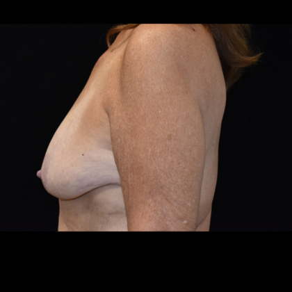 Mastopexy with Augmentation: Case 3 - Before