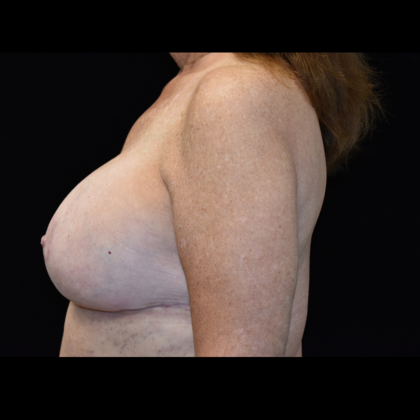 Mastopexy with Augmentation: Case 3 - After