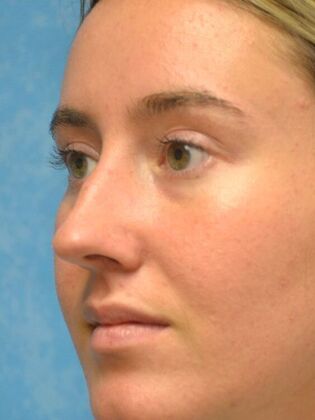 Rhinoplasty: Case 1723- Rossford, OH - Before