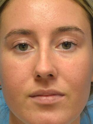 Rhinoplasty: Case 1723- Rossford, OH - Before