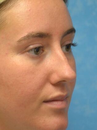 Rhinoplasty: Case 1723- Rossford, OH - Before