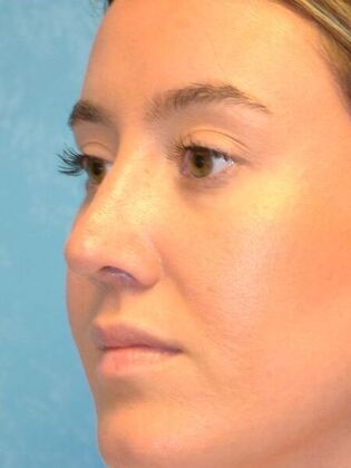 Rhinoplasty: Case 1723- Rossford, OH - After