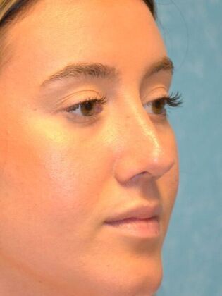 Rhinoplasty: Case 1723- Rossford, OH - After