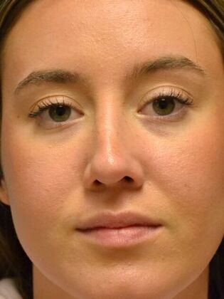 Rhinoplasty: Case 1723- Rossford, OH - After