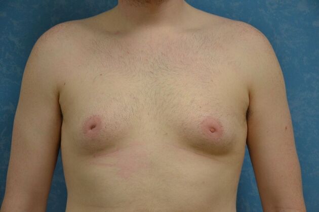 Gynecomastia Case 1513- Toledo, OH - Before