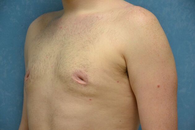 Gynecomastia: Case 1513- Toledo, OH - After