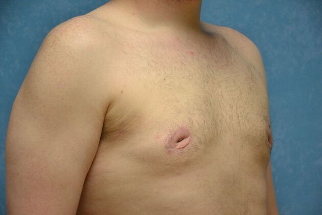 Gynecomastia: Case 1513- Toledo, OH - After