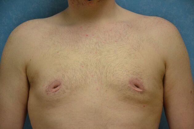 Gynecomastia Case 1513- Toledo, OH - After