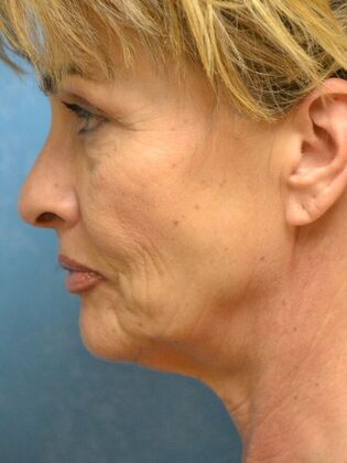 Face & Neck Lifts: Case 1749- Sylvania, OH - Before