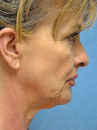 Face & Neck Lifts: Case 1749- Sylvania, OH - Before