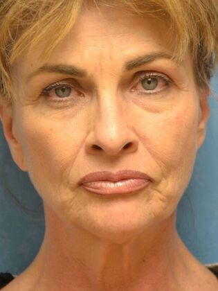 Face & Neck Lifts Case 1749- Sylvania, OH - Before
