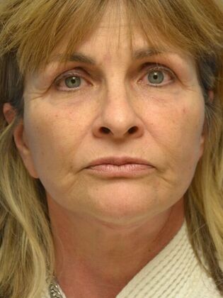 Face & Neck Lifts Case 1749- Sylvania, OH - After