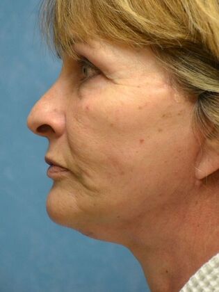 Face & Neck Lifts: Case 1749- Sylvania, OH - After