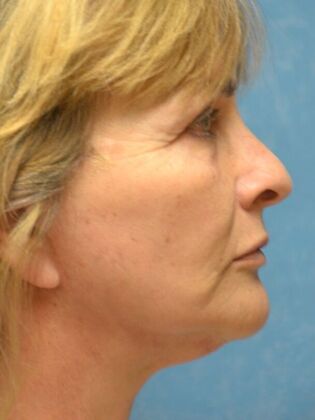 Face & Neck Lifts: Case 1749- Sylvania, OH - After