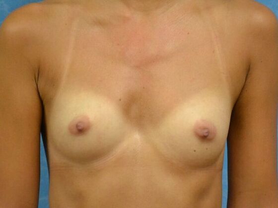 Breast Augmentation Case 1769- Toledo, OH - Before