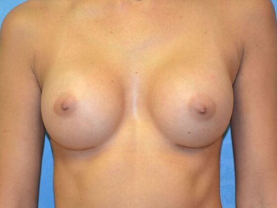 Breast Augmentation Case 1769- Toledo, OH - After