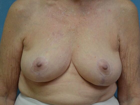 Breast Lift Case 1498- Holland, OH - After