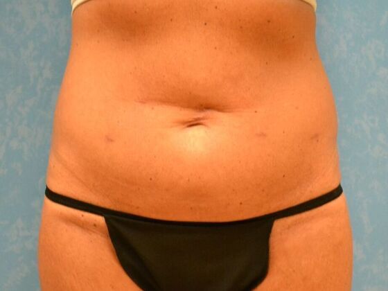 Tummy Tuck: Case 1813- Perrysburg, OH - Before