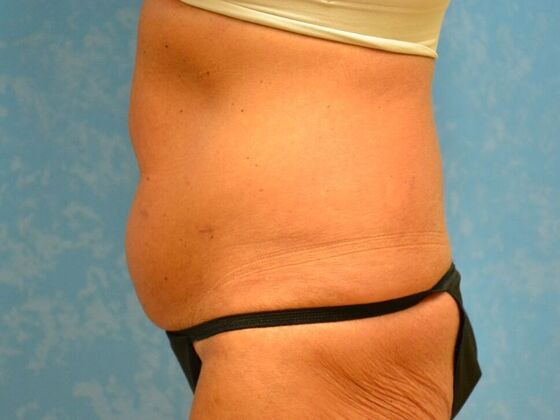 Tummy Tuck: Case 1813- Perrysburg, OH - Before