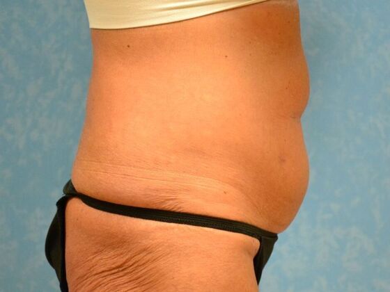 Tummy Tuck: Case 1813- Perrysburg, OH - Before