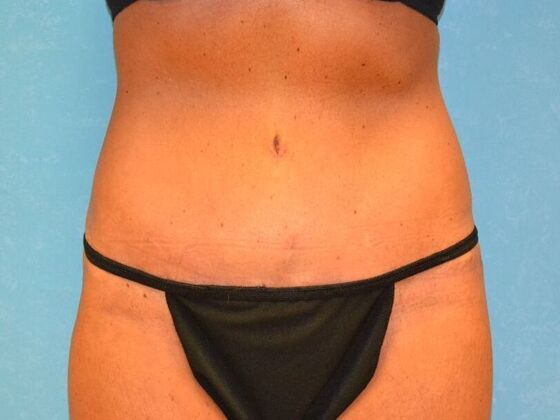 Tummy Tuck: Case 1813- Perrysburg, OH - After