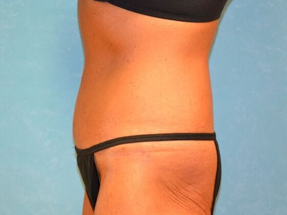 Tummy Tuck: Case 1813- Perrysburg, OH - After