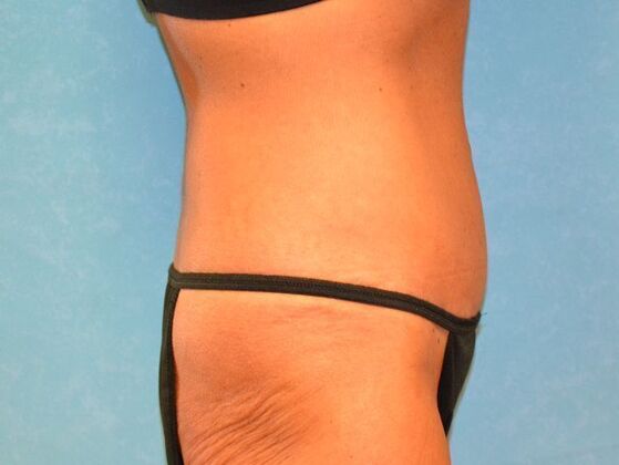 Tummy Tuck: Case 1813- Perrysburg, OH - After