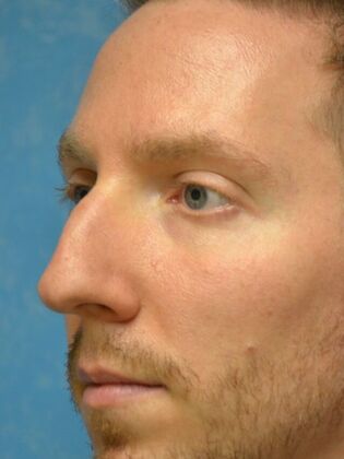 Rhinoplasty: Case 1733- Maumee, OH - Before