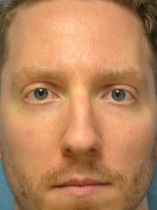 Rhinoplasty Case 1733- Maumee, OH - Before