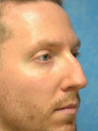Rhinoplasty: Case 1733- Maumee, OH - Before