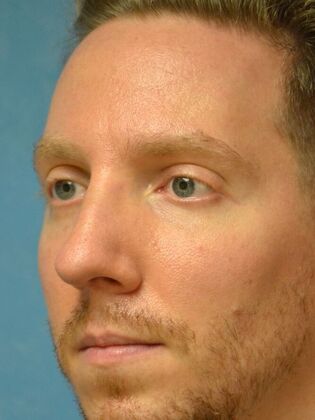 Rhinoplasty: Case 1733- Maumee, OH - After