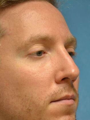 Rhinoplasty: Case 1733- Maumee, OH - After