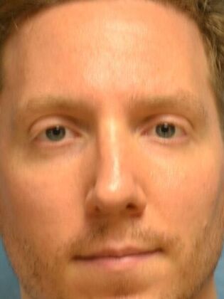 Rhinoplasty Case 1733- Maumee, OH - After