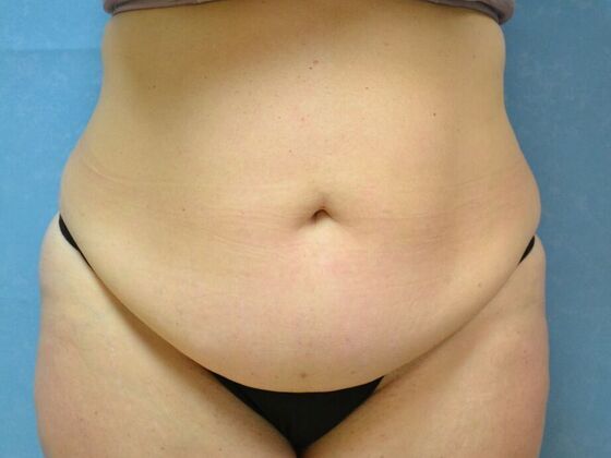 Tummy Tuck: Case 1797- Toledo, OH - Before