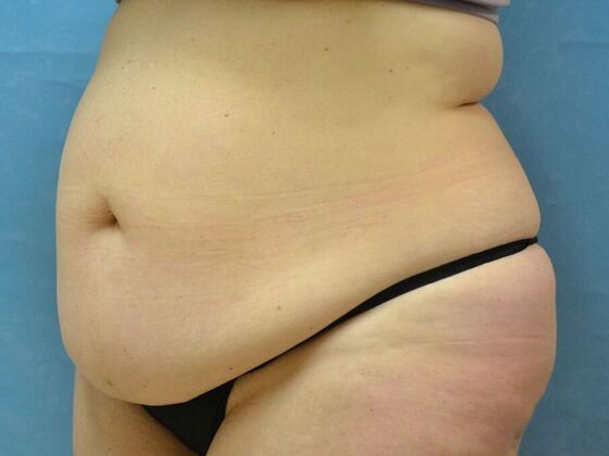 Tummy Tuck: Case 1797- Toledo, OH - Before