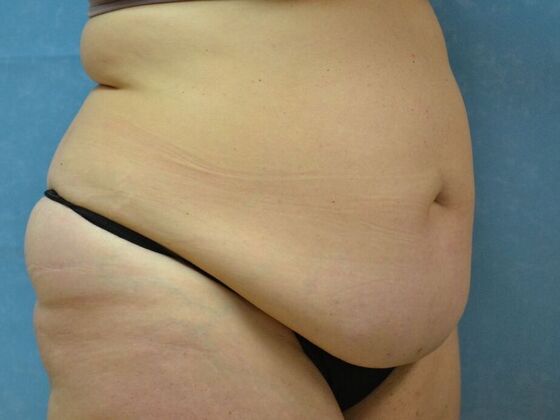 Tummy Tuck: Case 1797- Toledo, OH - Before
