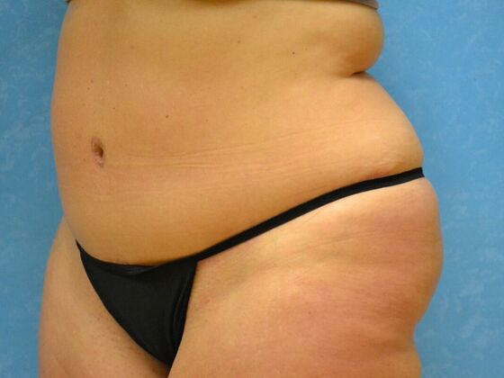 Tummy Tuck: Case 1797- Toledo, OH - After
