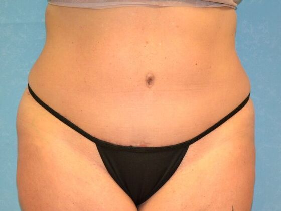 Tummy Tuck: Case 1797- Toledo, OH - After