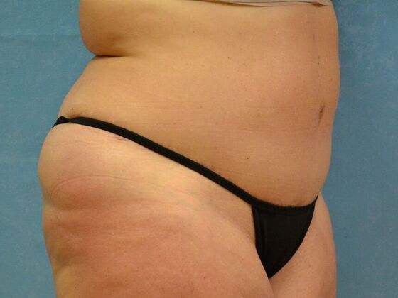 Tummy Tuck: Case 1797- Toledo, OH - After