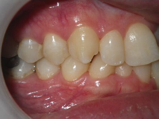 Orthodontics: Case 1 - Before