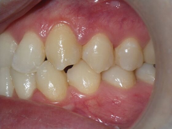 Orthodontics: Case 1 - Before
