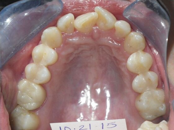 Orthodontics: Case 1 - Before