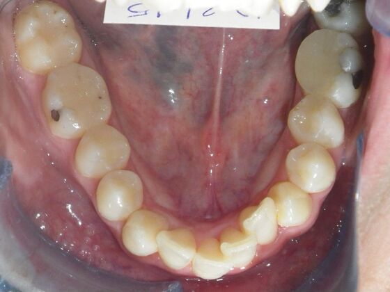 Orthodontics: Case 1 - Before