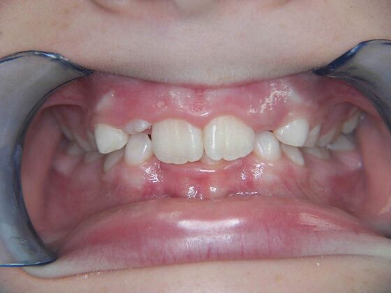 Orthodontics: Case 2 - Before